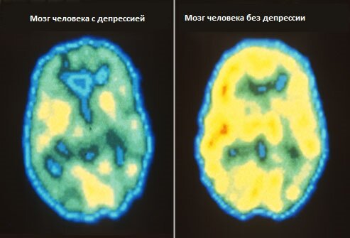 Мозг человека с депрессией