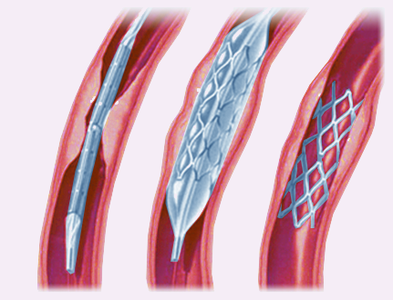  Ангиопластика артерий стоп 